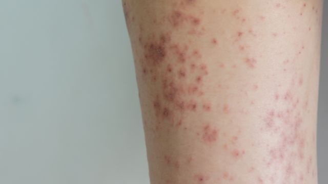 Limpeza das mãos ajuda a evitar dermatites